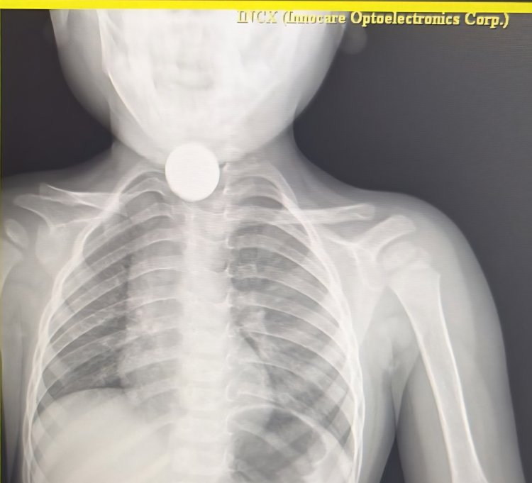 3 साल के बच्चे ने खेलते खेलते निगल लिया 5 का सिक्का