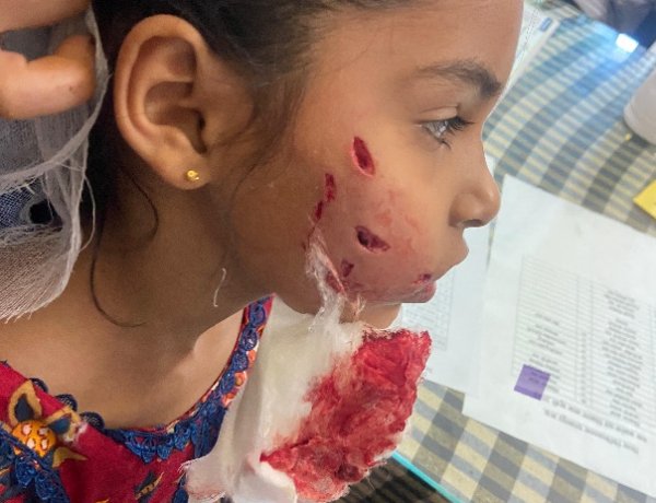 पागल कुत्ते ने मासूम के गाल और जबड़े पर आई गंभीर चोंट   कुत्ते के हमले में घायल हुई मासूम।