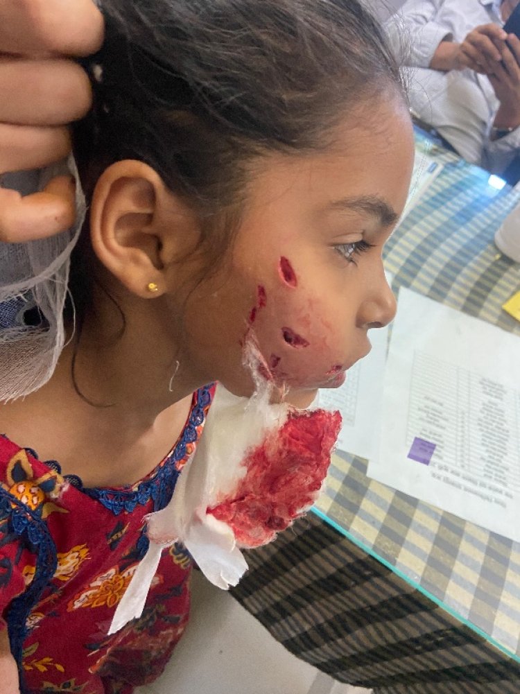 पागल कुत्ते ने मासूम के गाल और जबड़े पर आई गंभीर चोंट   कुत्ते के हमले में घायल हुई मासूम।
